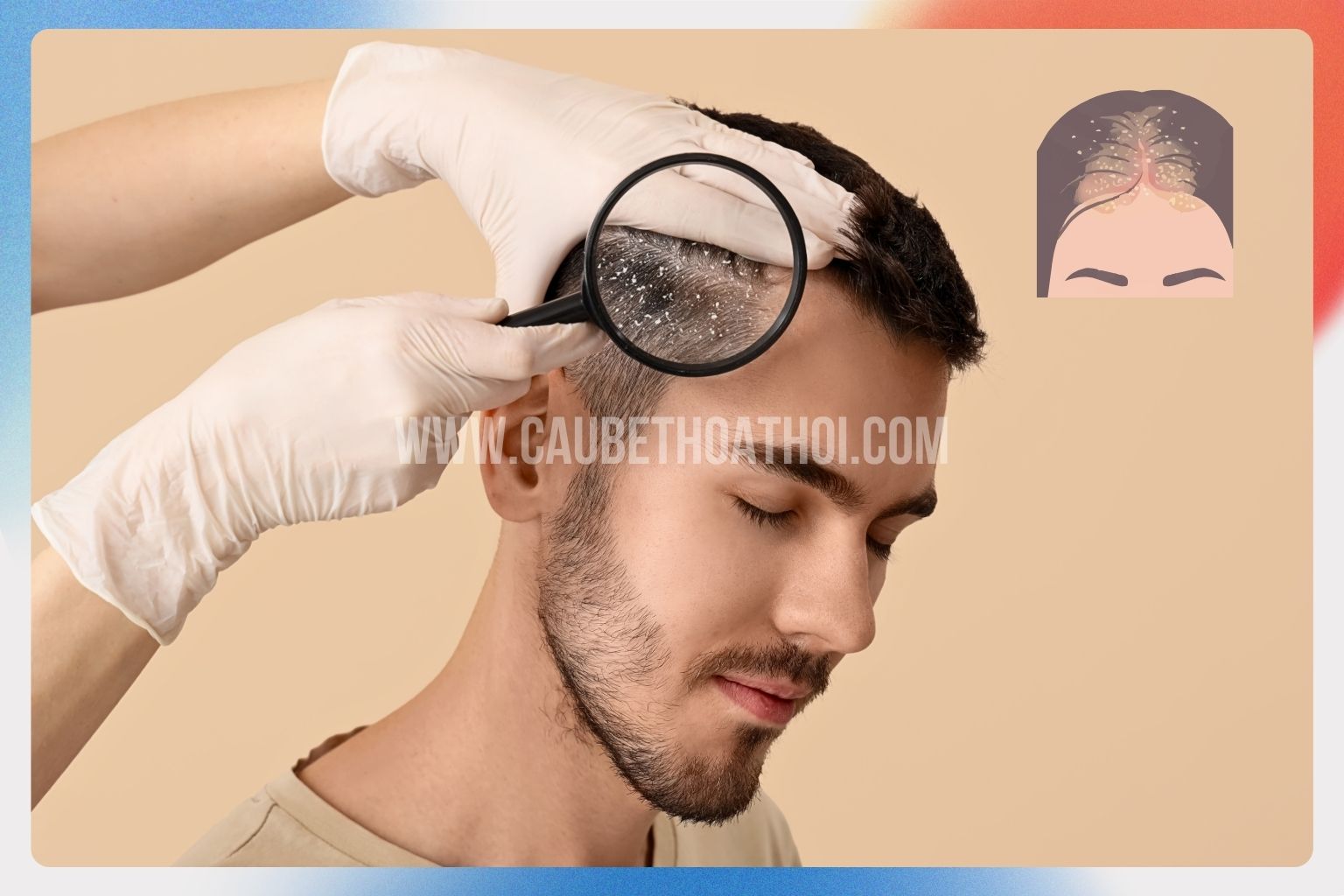 Bác sĩ đang dùng kính soi da đầu thăm khám xem người bị viêm da tiết bã có cấy tóc được không