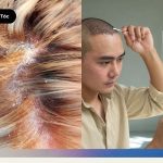 Bác sĩ đang dùng kính soi da đầu thăm khám xem người bị viêm da tiết bã có cấy tóc được không