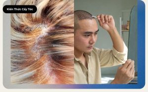 Bác sĩ đang dùng kính soi da đầu thăm khám xem người bị viêm da tiết bã có cấy tóc được không