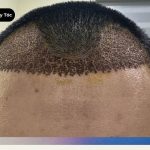 Sẹo cấy tóc: Phương pháp FUT, FUE và DHI có để lại sẹo không? Sẹo sau cấy tóc