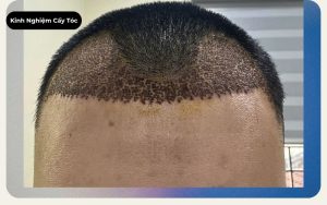 Sẹo sau cấy tóc