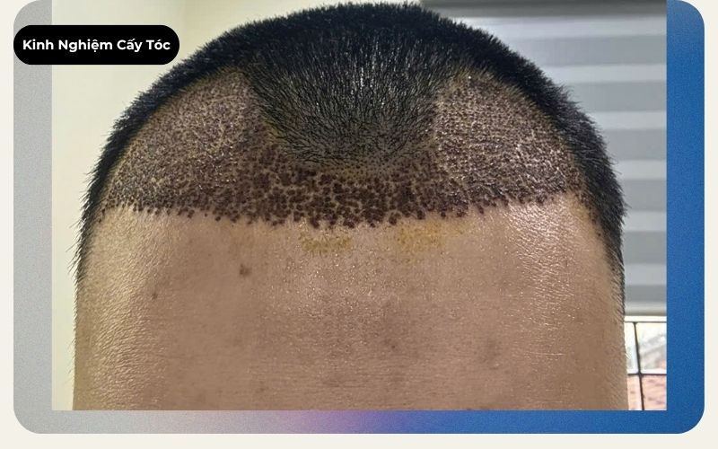 Sẹo sau cấy tóc