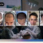 Biểu Đồ Tăng Trưởng Sau Cấy Tóc Từ Tuần 1 Đến Tháng 12 Ảnh bìa thể hiện biểu đồ tăng trưởng sau cấy ghép tóc chi tiết qua các cột mốc tuần 1 tháng 1 tháng 3 tháng 6 và tháng 12