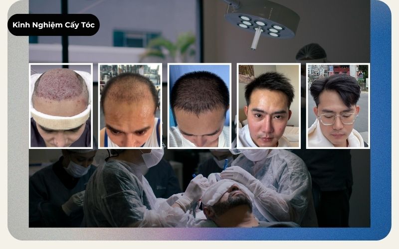Ảnh bìa thể hiện biểu đồ tăng trưởng sau cấy ghép tóc chi tiết qua các cột mốc tuần 1 tháng 1 tháng 3 tháng 6 và tháng 12