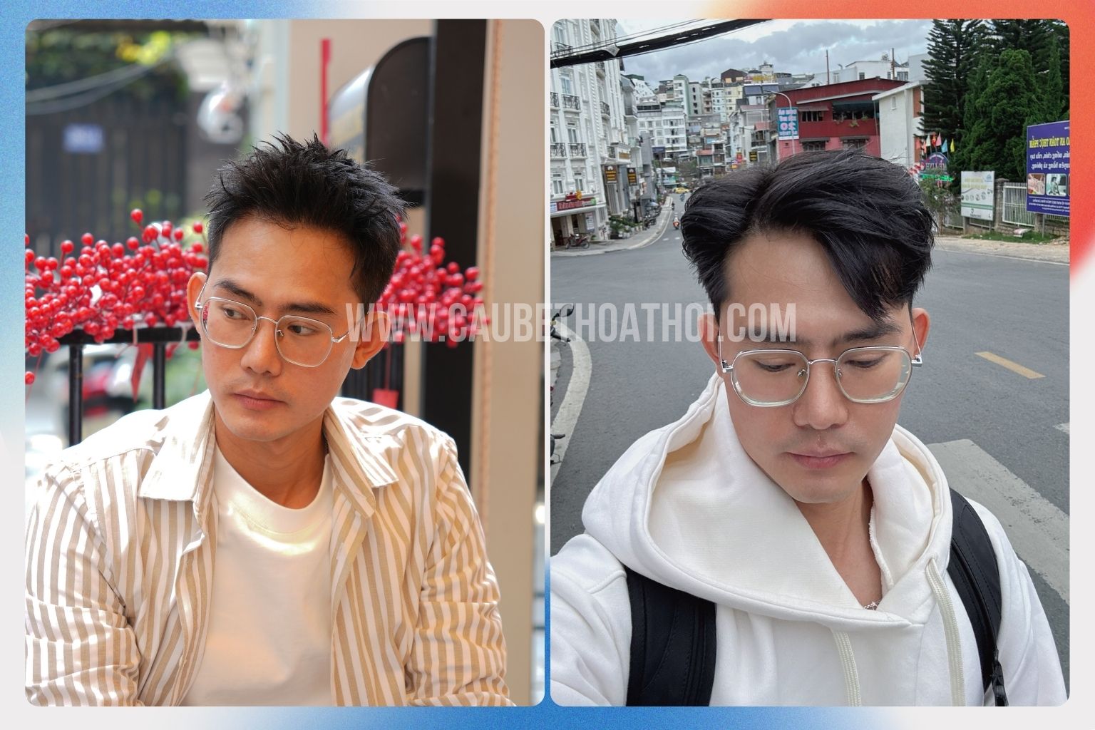 Hình ảnh kết quả cấy ghép tóc hoàn thiện sau 12 tháng với mật độ dày mượt và tự nhiên