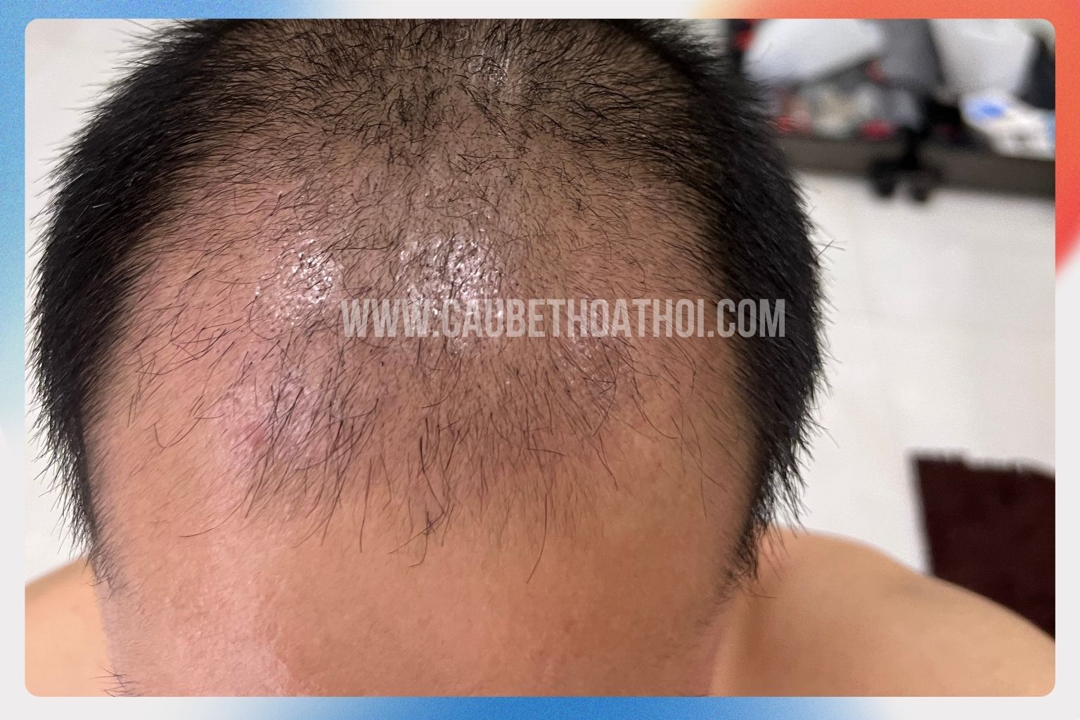 Hình ảnh rụng tóc do sốc sau 1 tháng cấy ghép tóc khi phần thân tóc cũ rụng đi để chuẩn bị mọc tóc mới