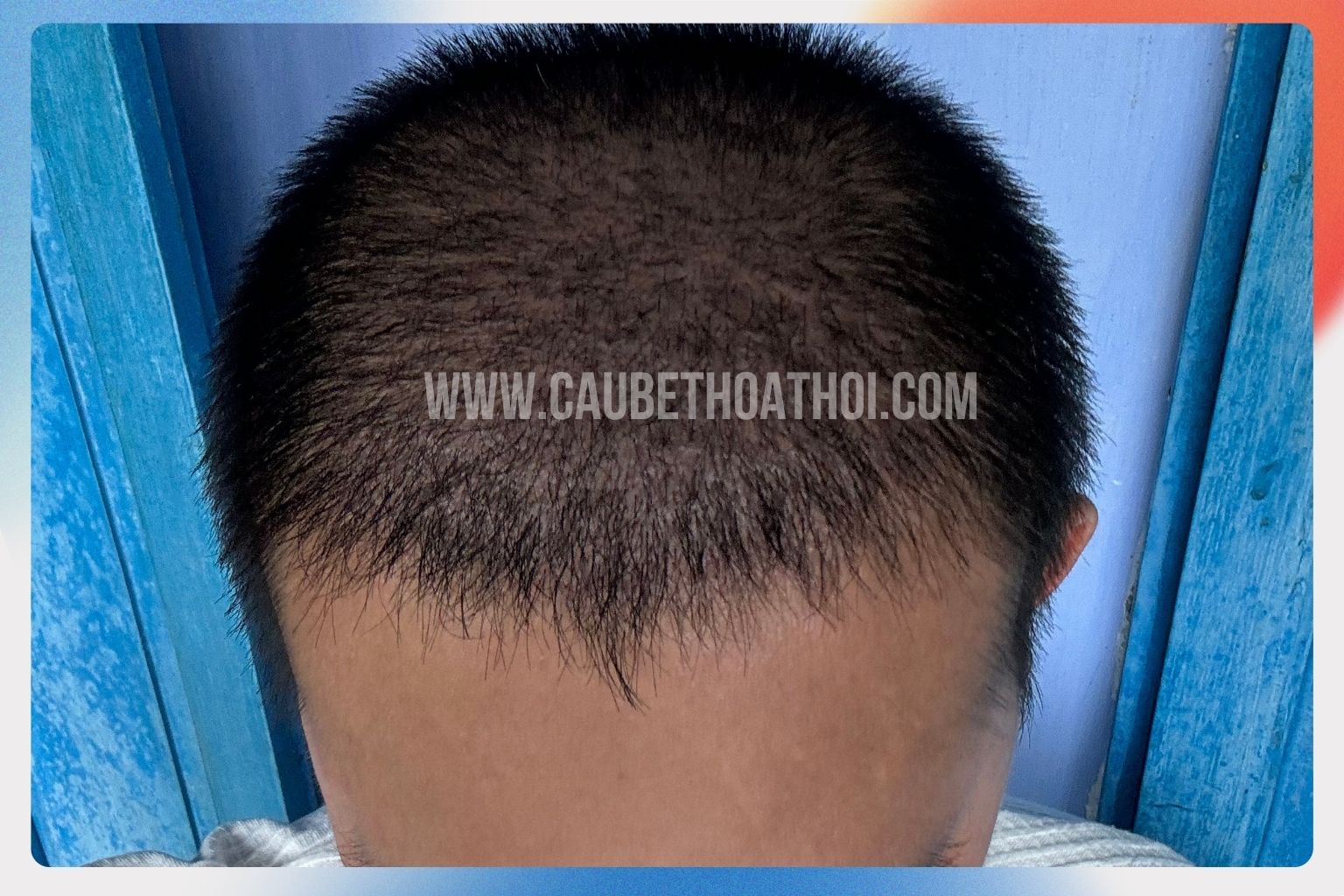 Hình ảnh tóc mới nhú mỏng nhẹ rải rác ở tháng thứ 3 trong biểu đồ tăng trưởng sau cấy ghép tóc