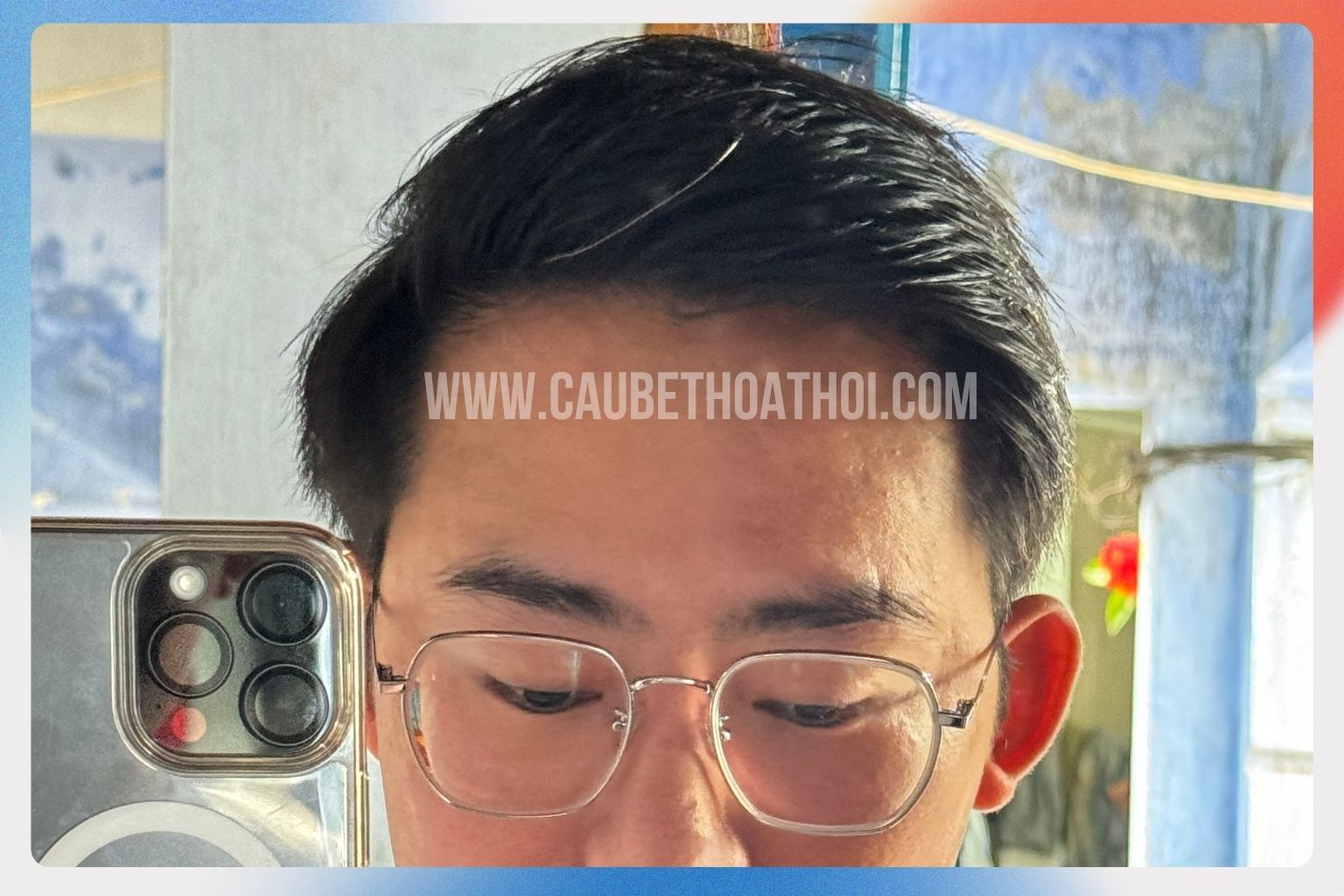 Hình ảnh mái tóc thô dày chắc khỏe và hòa quyện tự nhiên ở tháng thứ 8 sau cấy ghép tóc