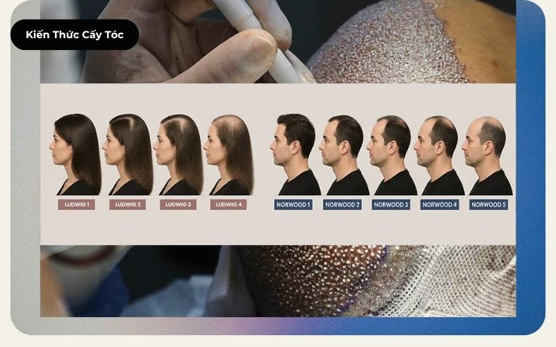 Ảnh bìa bài viết phân tích nguyên nhân rụng tóc do di truyền ở nam và nữ cùng các phương pháp điều trị chuẩn y khoa
